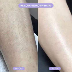 Before and after ingrown hair removal on leg.