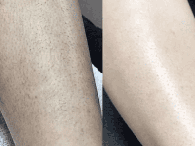 Before and after ingrown hair removal on leg.