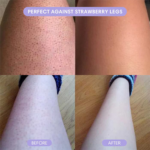 Comparison of legs before and after treatment