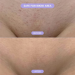 Before and after bikini area skin treatment.