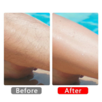 Before and after hair removal treatment comparison